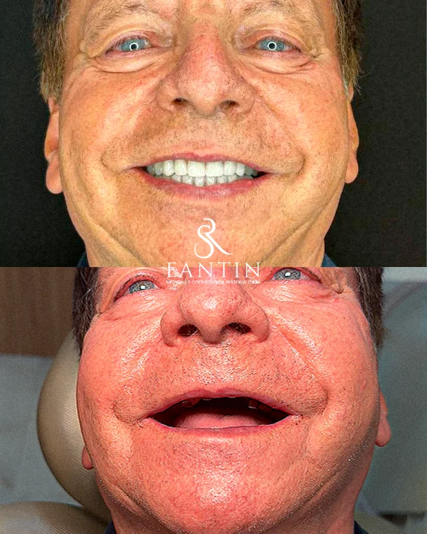 Antes e depois de prótese protocolo fixa — Fantin Odonto Santana